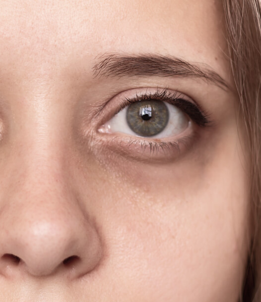 Forehead Lines