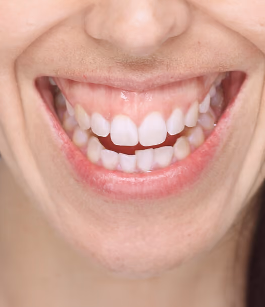 Gummy Smile Treatment