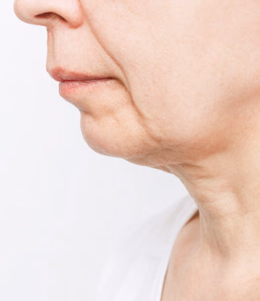 Sagging Jowls Treatment
