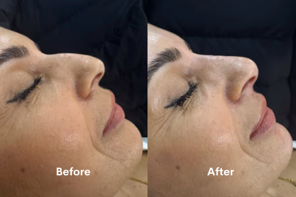 Non-surgical rhinoplasty treatment Solihull clinic