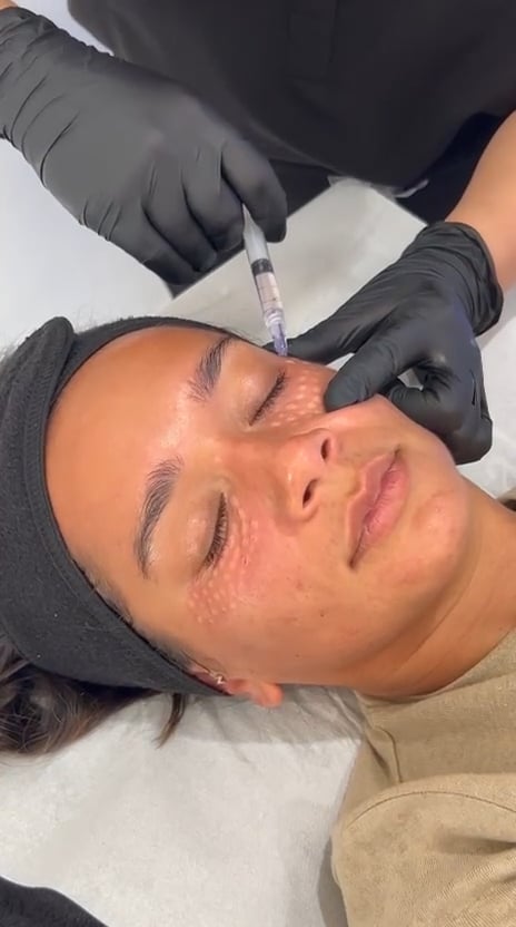 NCTF undereye treatment