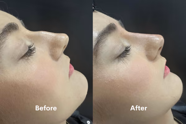 Non-surgical rhinoplasty treatment Solihull clinic