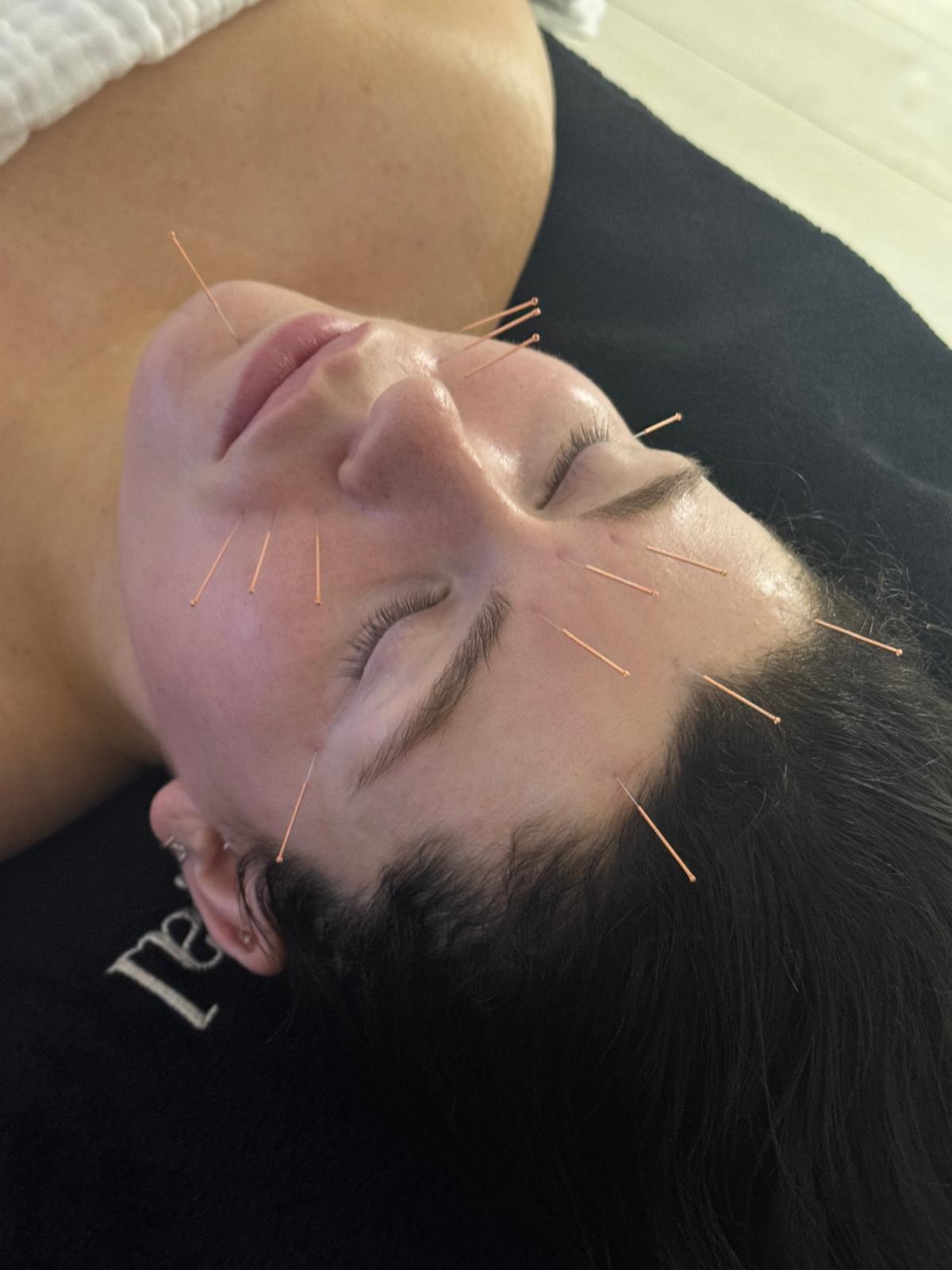 cosmetic acupuncture facial 
