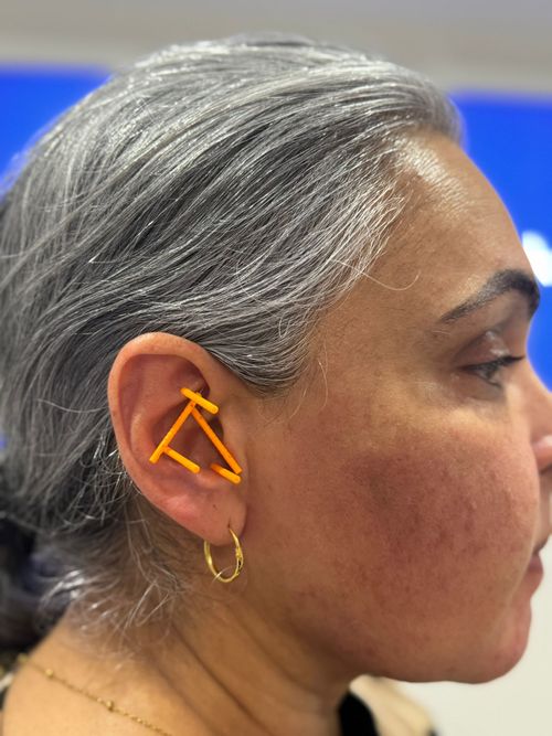 facial sculpting treatment