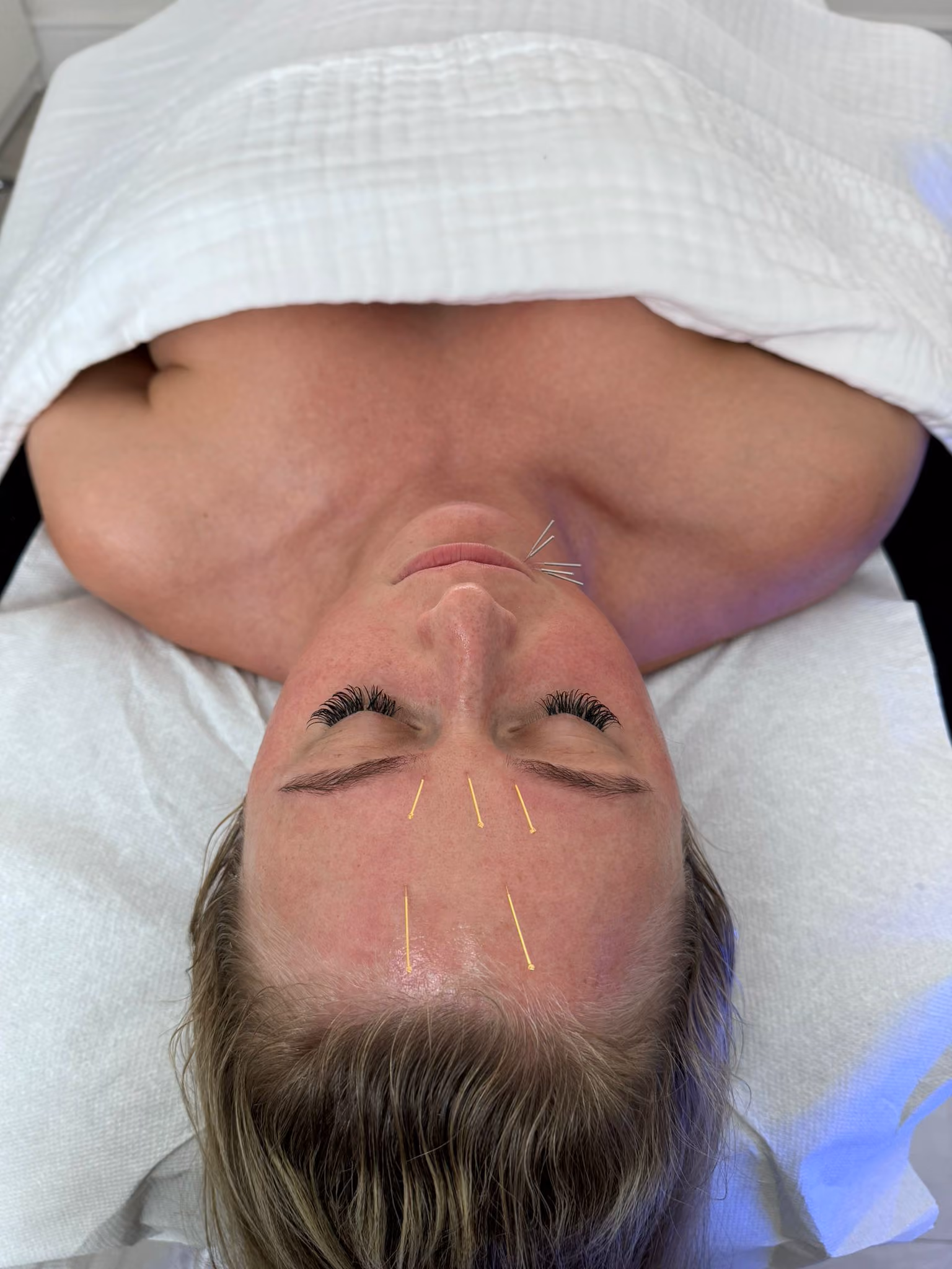SkinPen Treatment