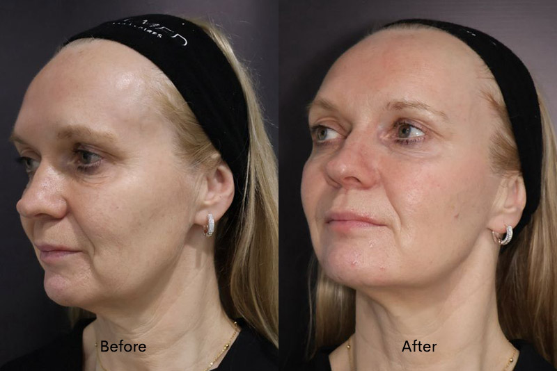 Non-surgical facelift in Solihull – 8-point facelift treatment overview