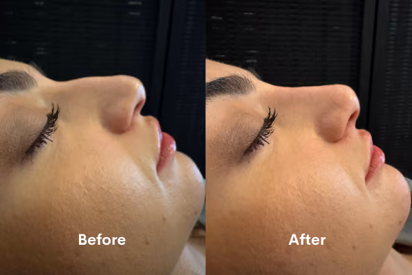 Non-surgical rhinoplasty treatment Solihull clinic