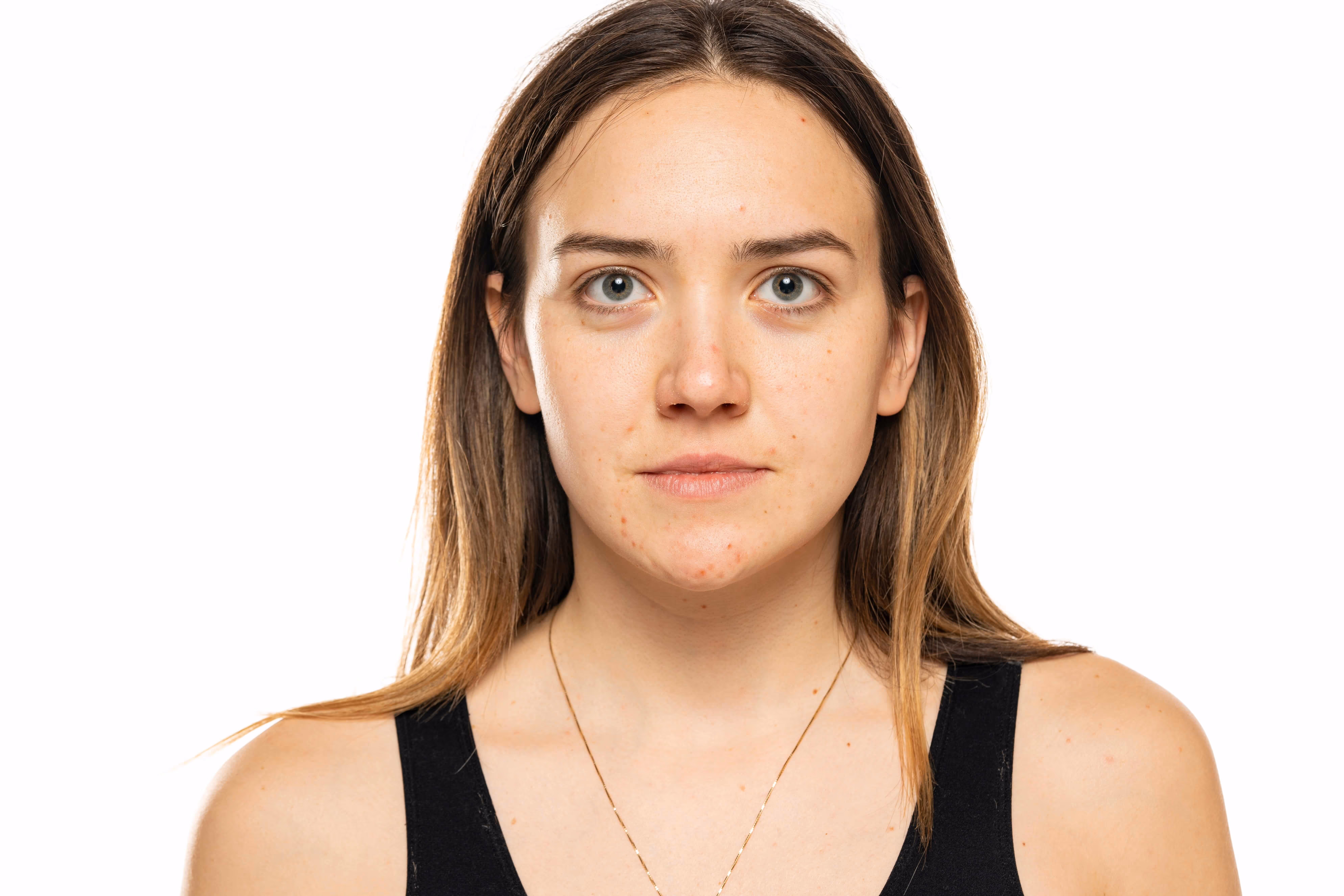 Why Choose AL Aesthetics for Anti-Wrinkle Treatment in Solihull?