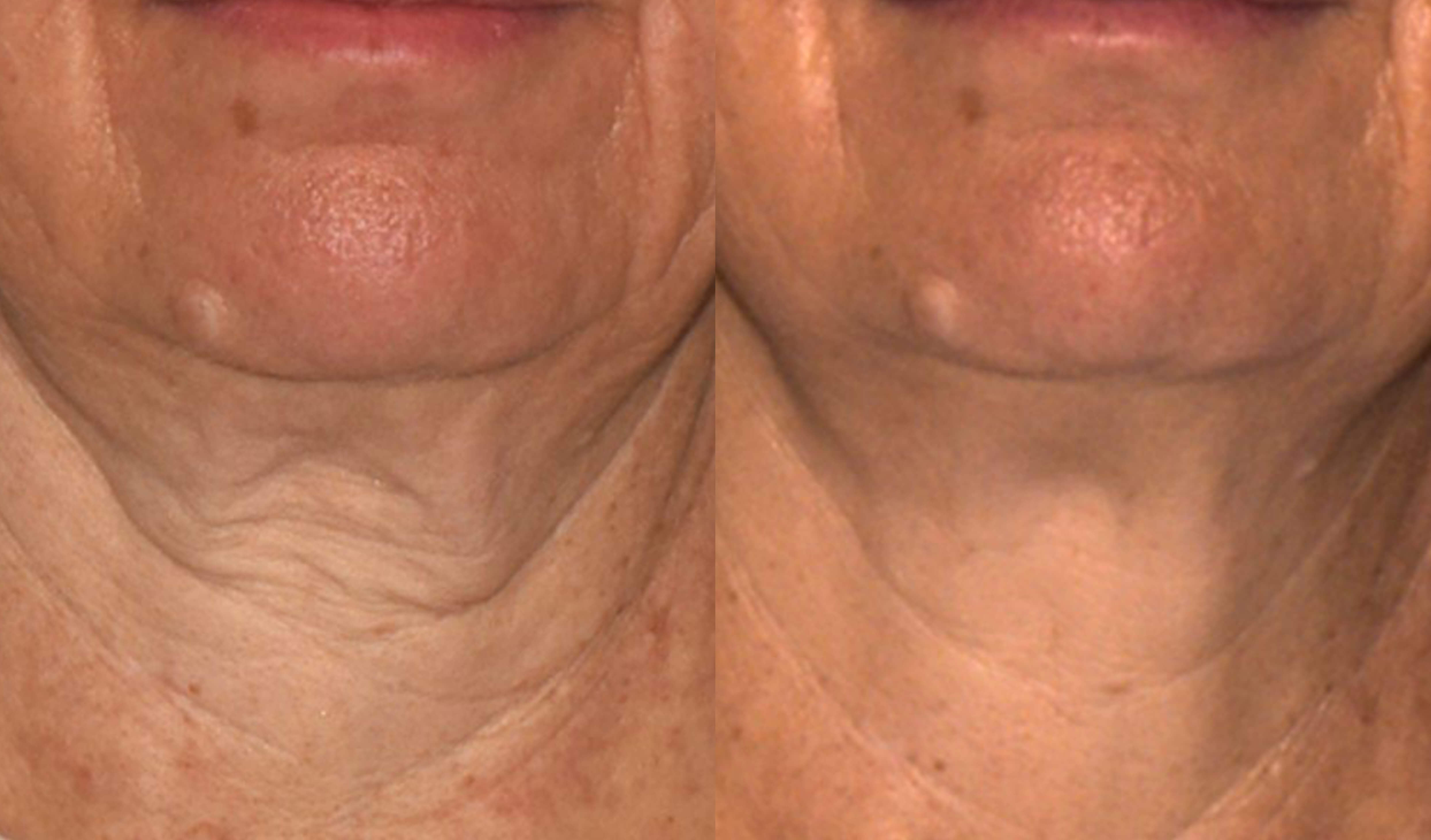 Before and After Treatment
