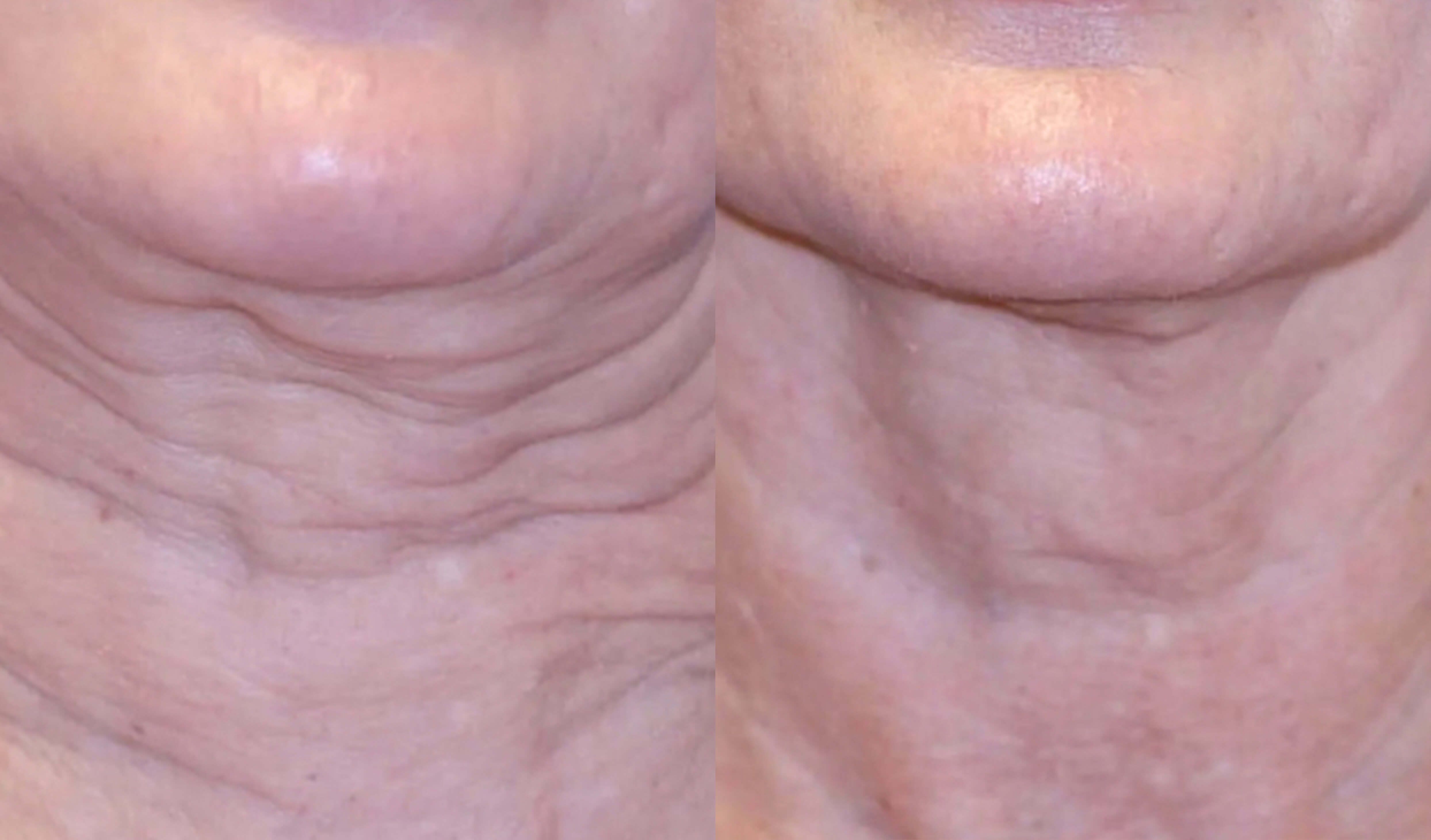Before and After Treatment