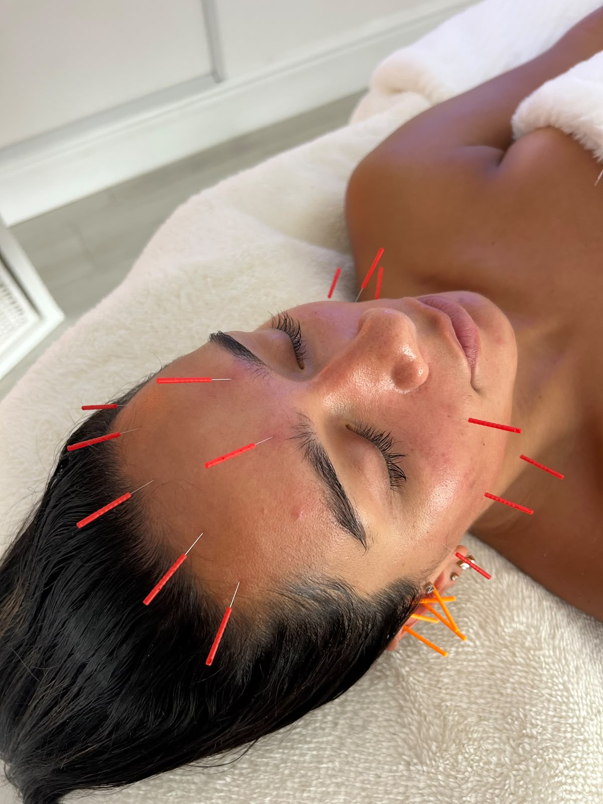 SkinPen Treatment