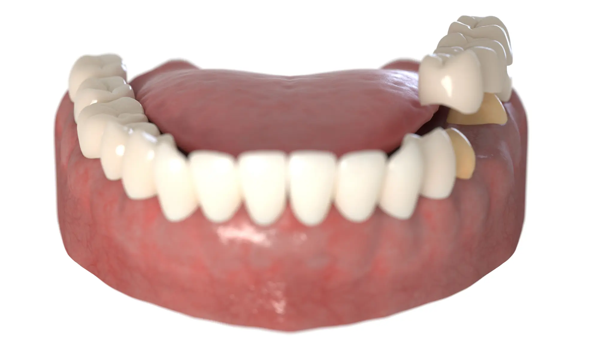 Can a Dental Bridge Improve Chewing After Tooth Loss?