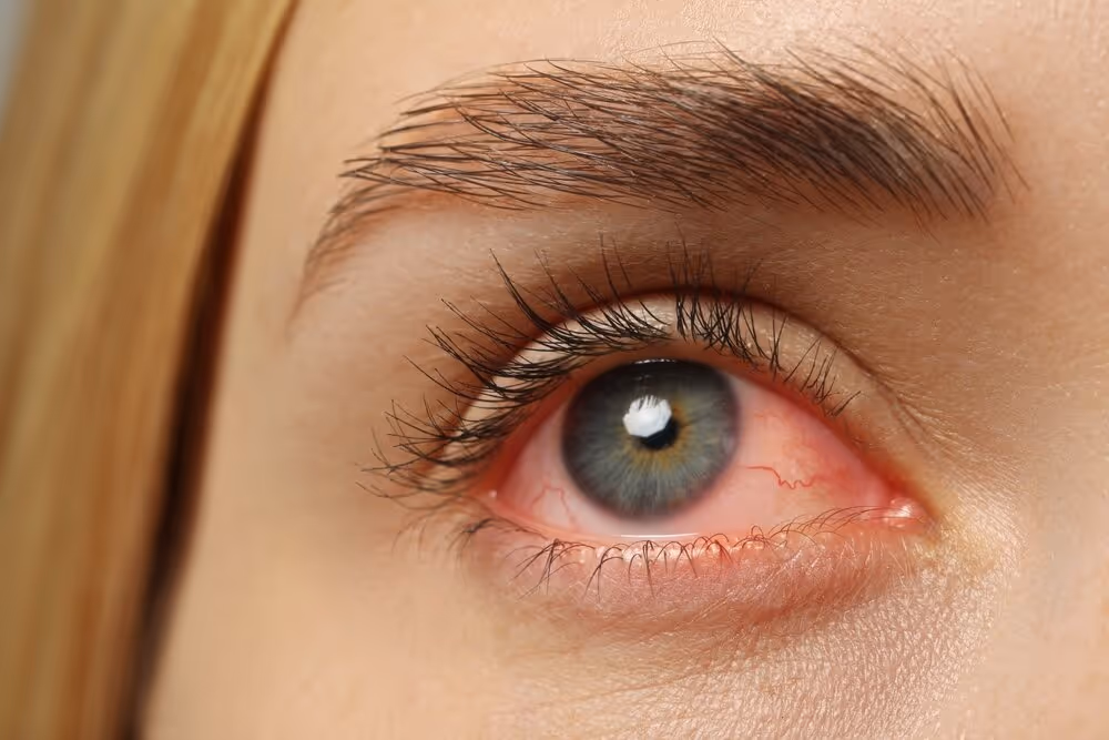 Understanding Dry Eye Syndrome: Insights from Merivale Vision Care