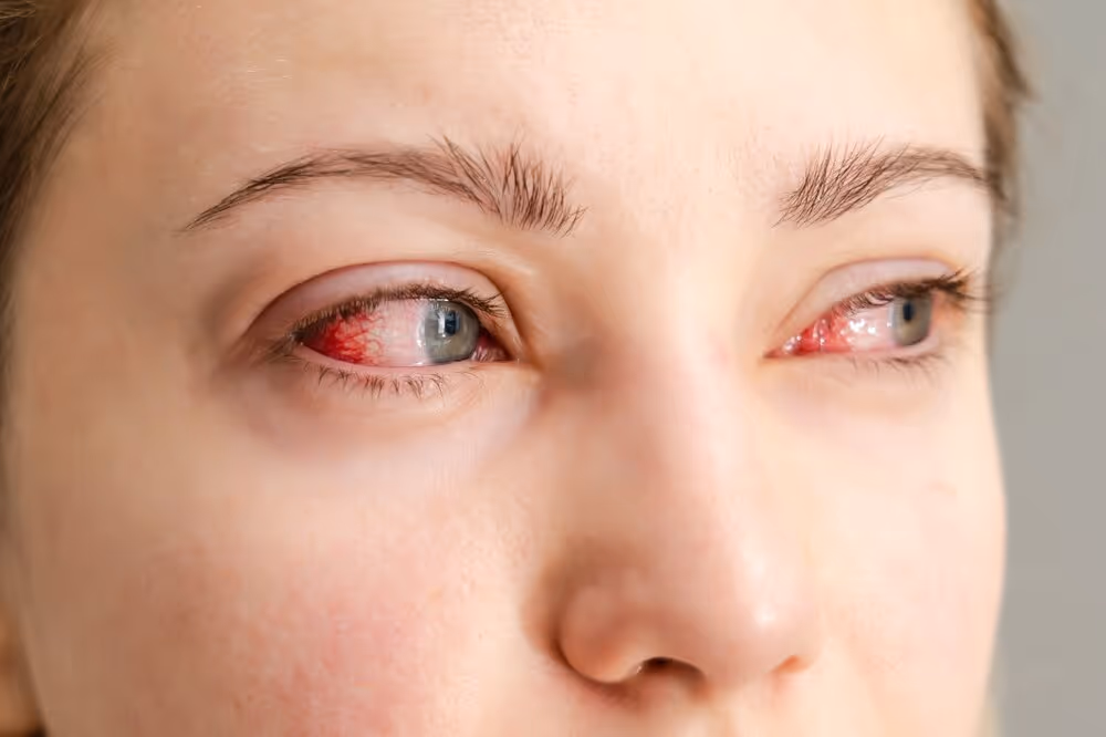 Woman with Dry Eye Symptoms