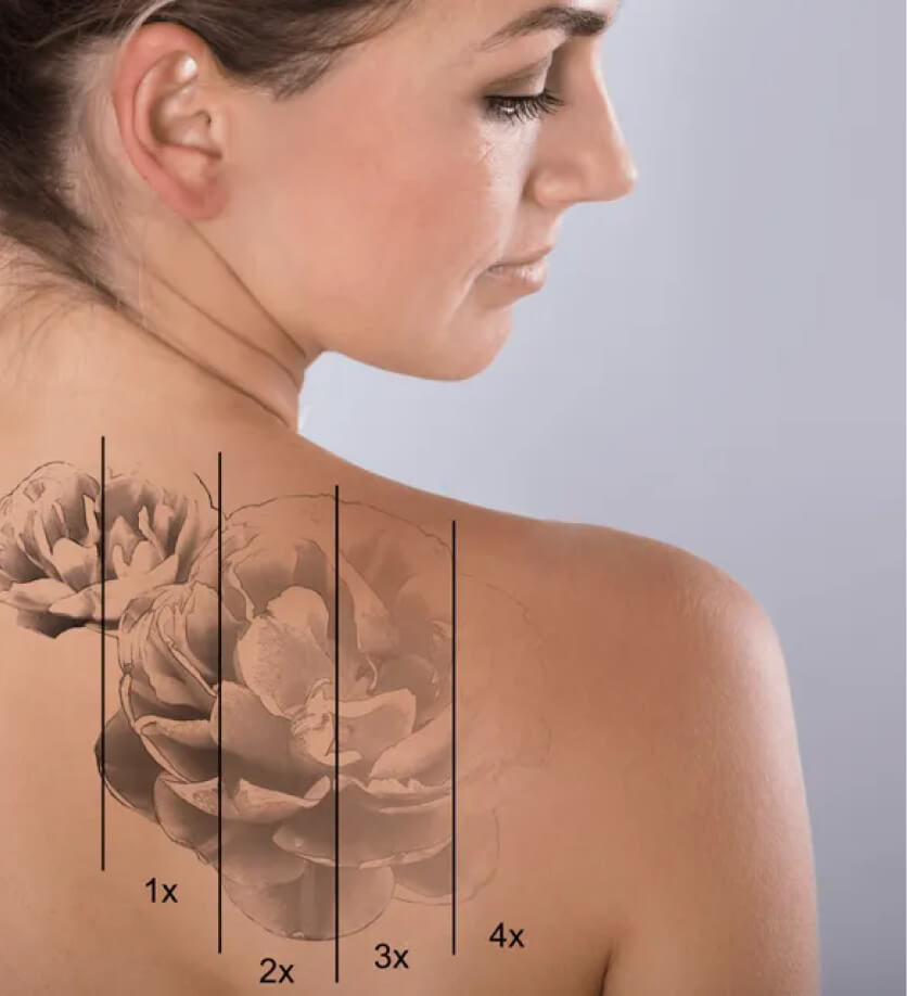 Laser Tattoo Removal