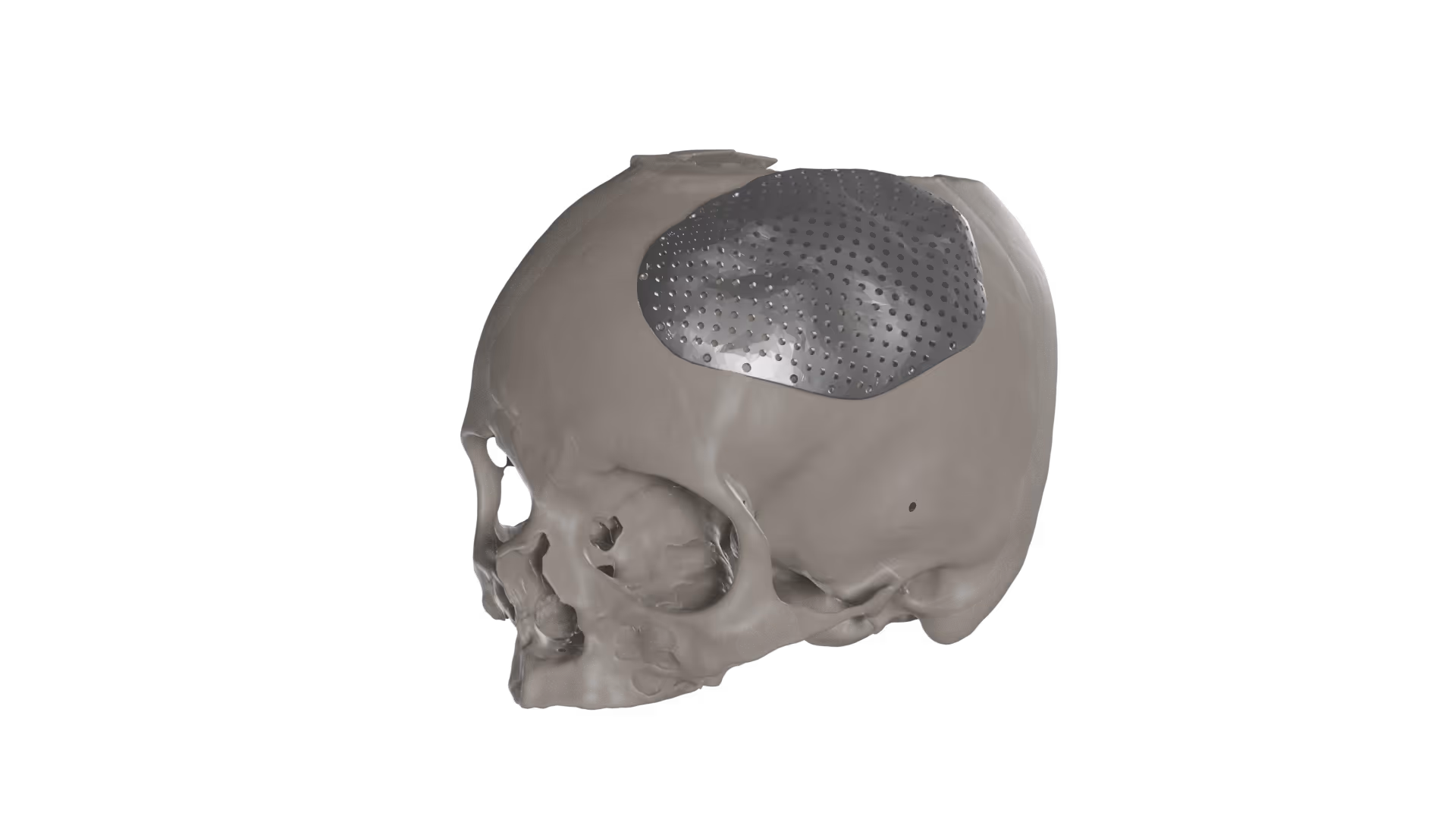 Accurate CT and CBCT segmentation are the basis of a qualitative patient specific implant.