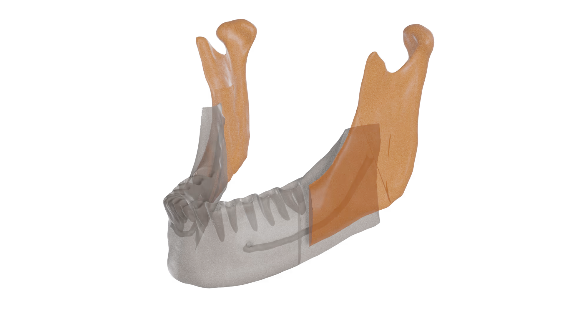 Leverage the Relu® Engine in oral and maxillofacial surgery software to create guides in a faster and more accurate way. 