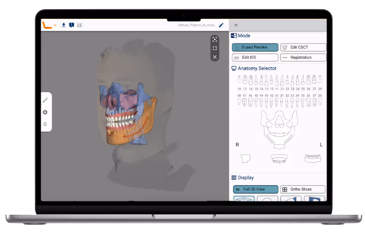 Computer screen showing Relu® Creator software with a virtual patient where the CBCT segmentations, the intra-oral scans and the facial scan are all aligned