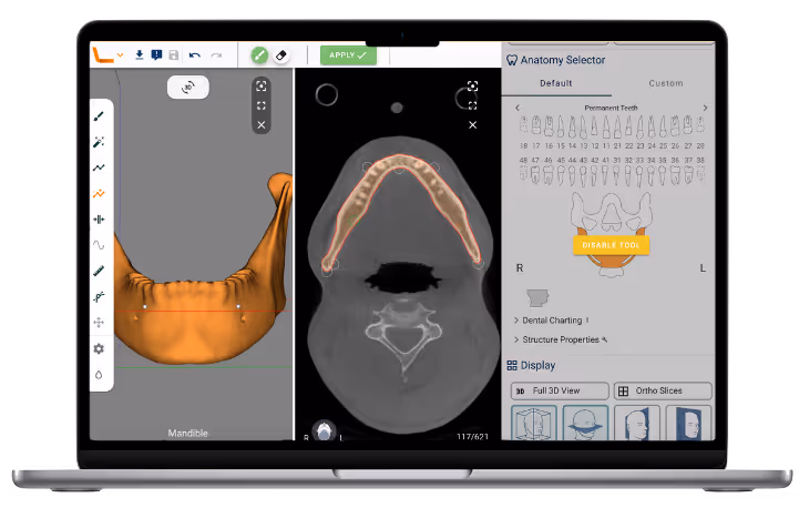 Computer screen showing Relu® Creator software used to segment a mandible on a cone beam CT