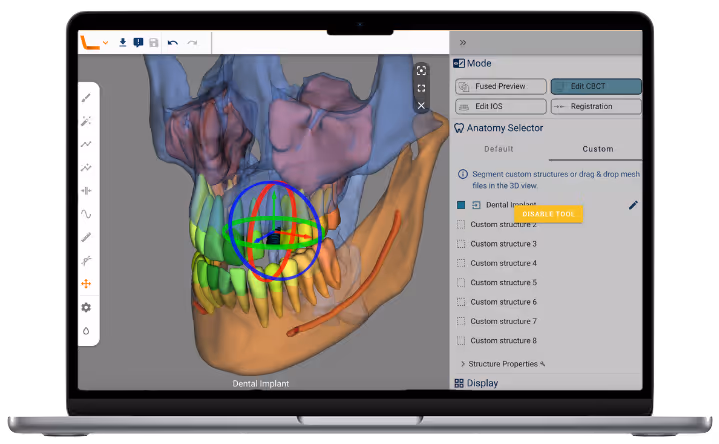 Computer screen showing Relu® Creator software used to position custom structures on the virtual patient
