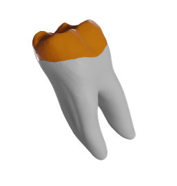 Crown from intraoral scan and root from CBCT