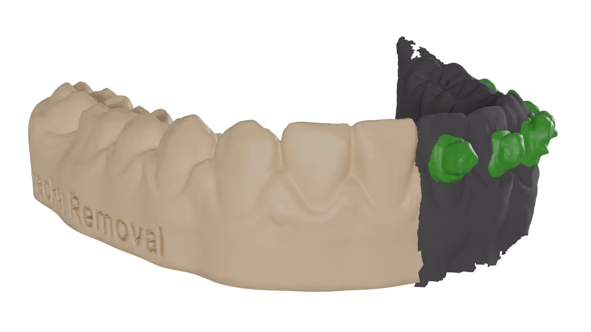 orthodontic model with brackets removed