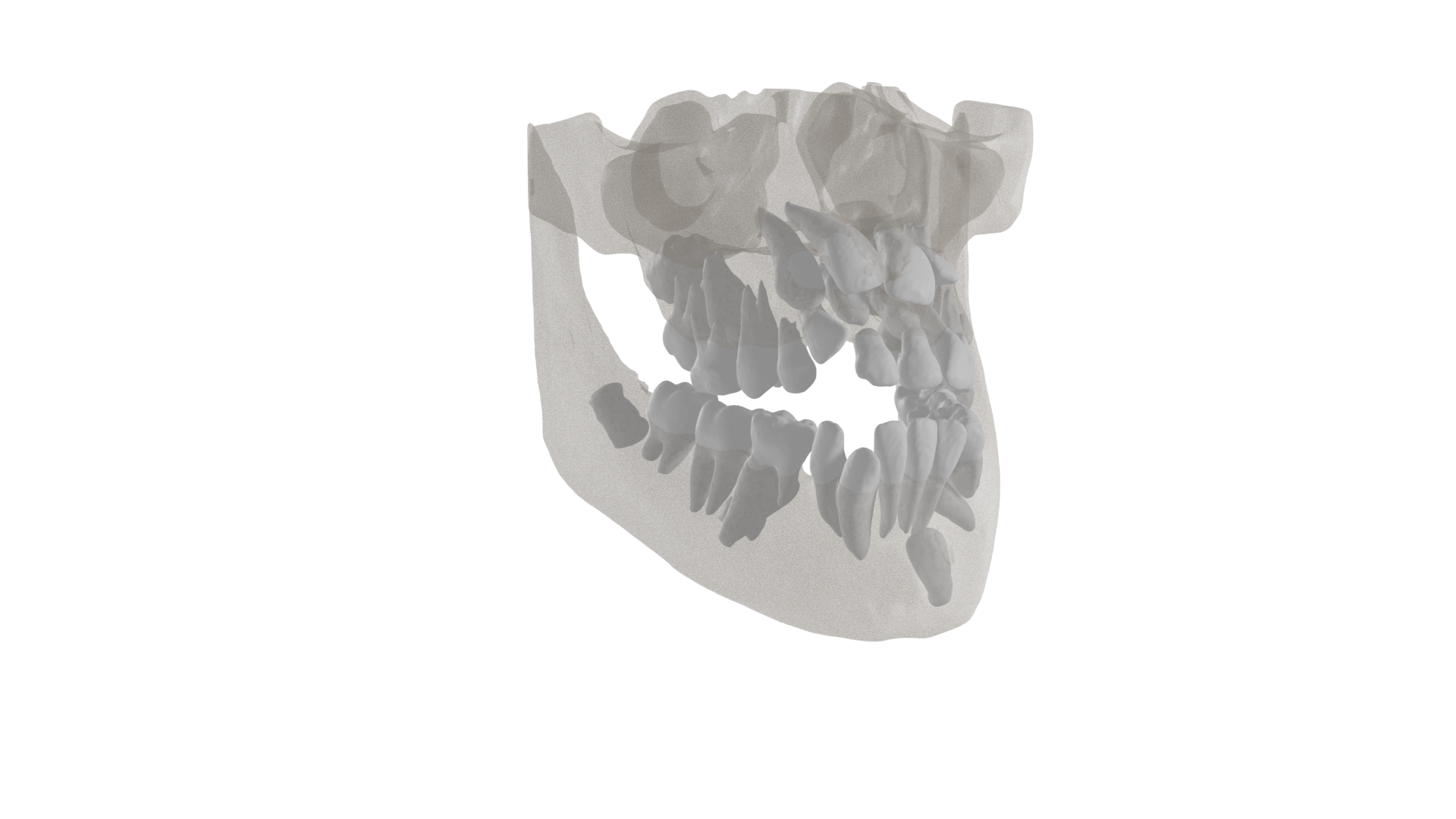 Segmentation of deciduous teeth on CBCT.