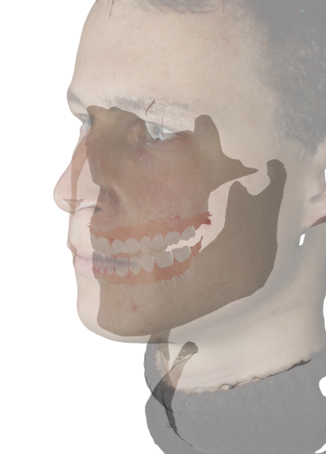 A facial scan aligned with a CBCT
