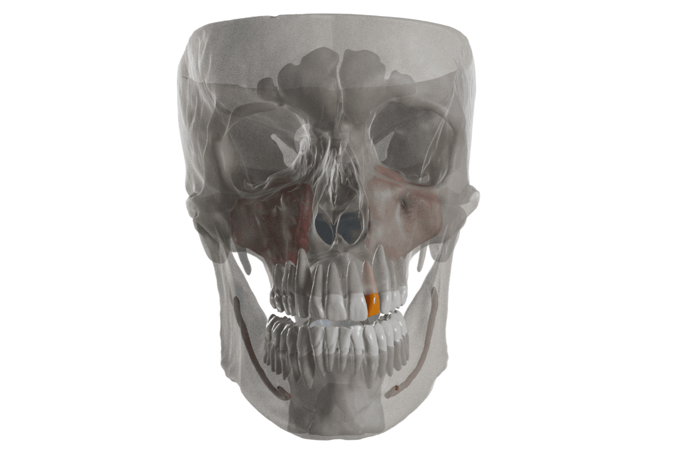 Full segmentation of CBCT and IOS.