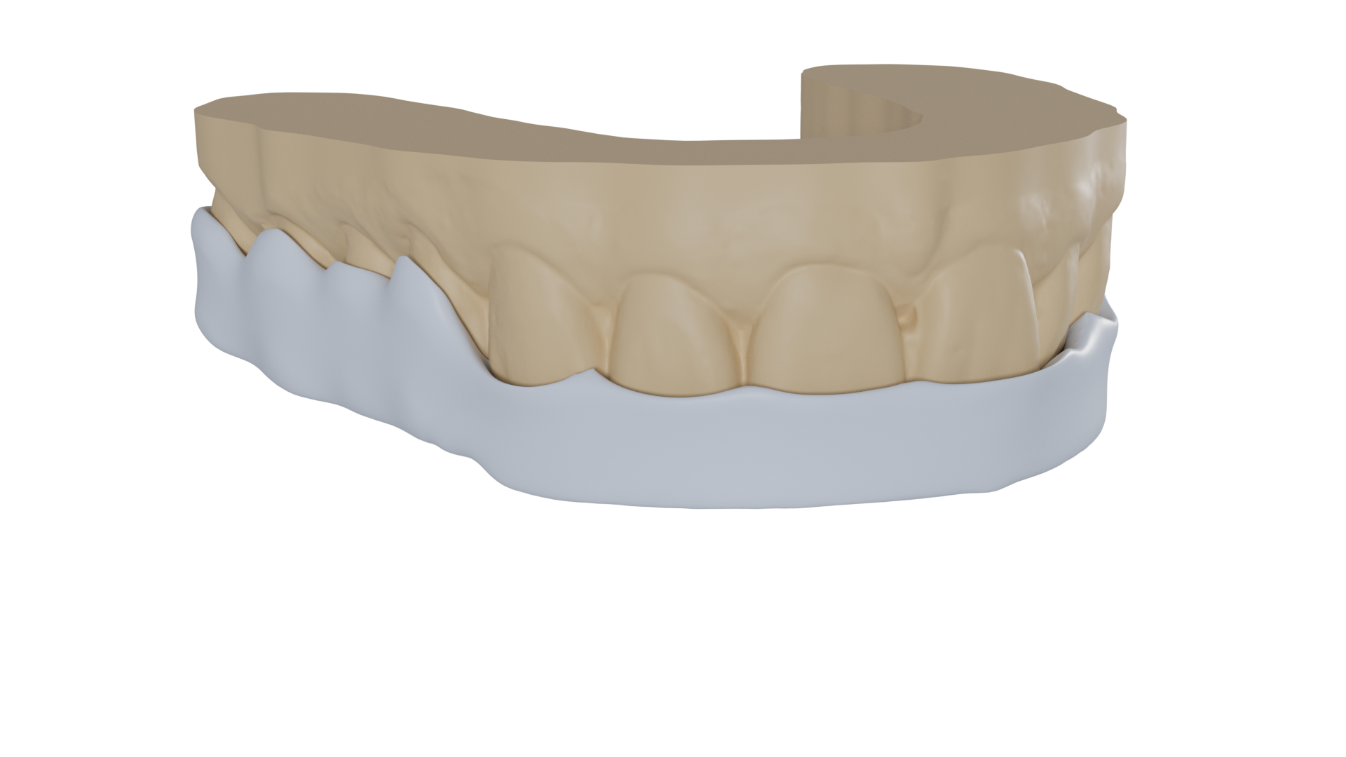 dental splints