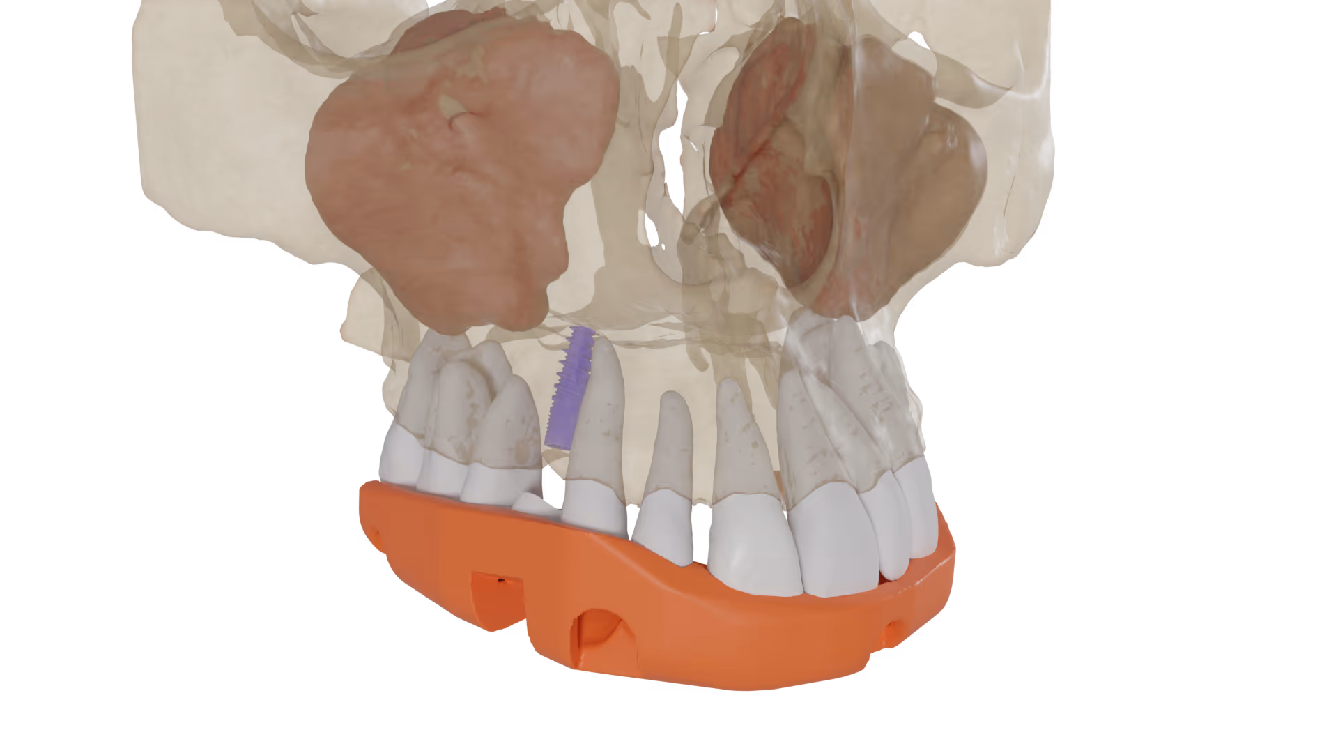 Used by dental laboratories worldwide to automate routine crown and bridge cases while maintaining full technician control.