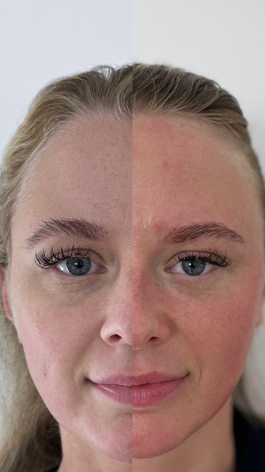 AcuFirm Natural Facelift