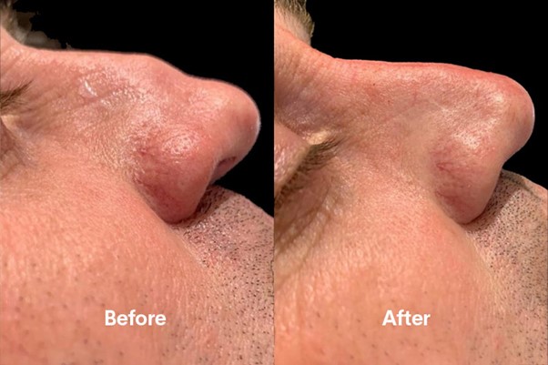 Before and after result