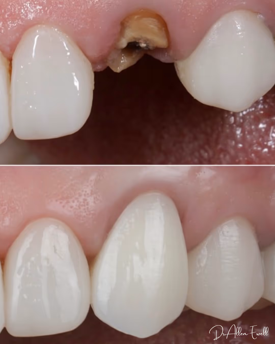Before and After - Smile Gallery - Dentistry of Arizona