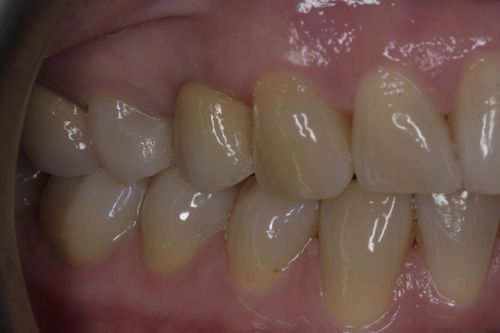 After dental implant treatment