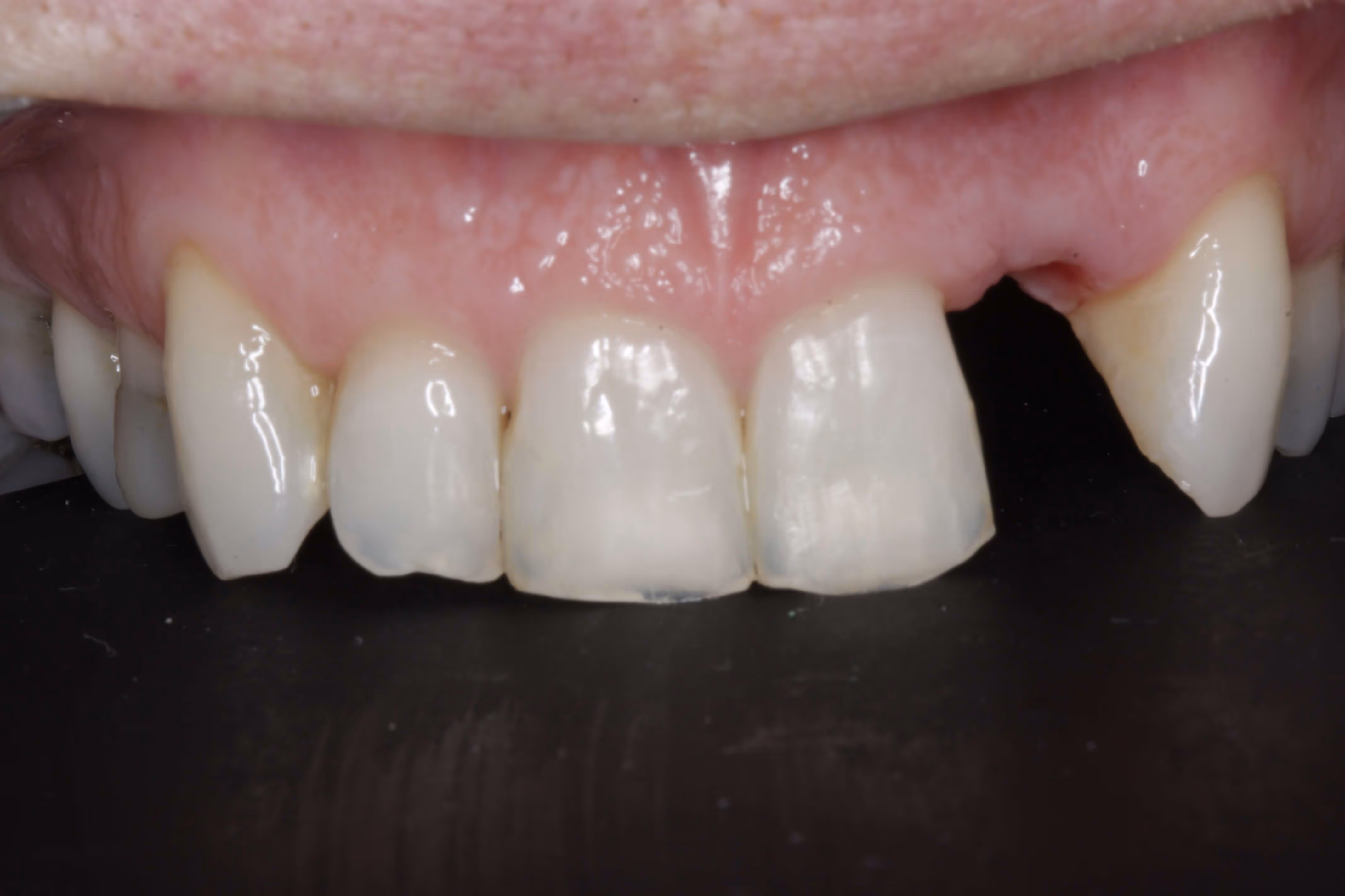 Before dental implant treatment