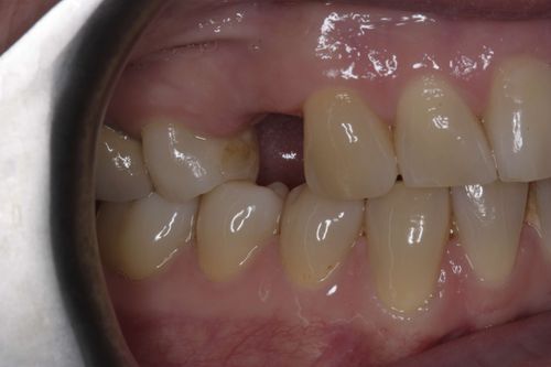 Before dental implant treatment