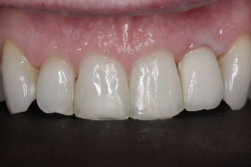 After dental implant treatment