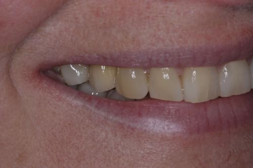 After dental implant treatment