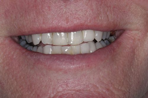 After dental implant treatment