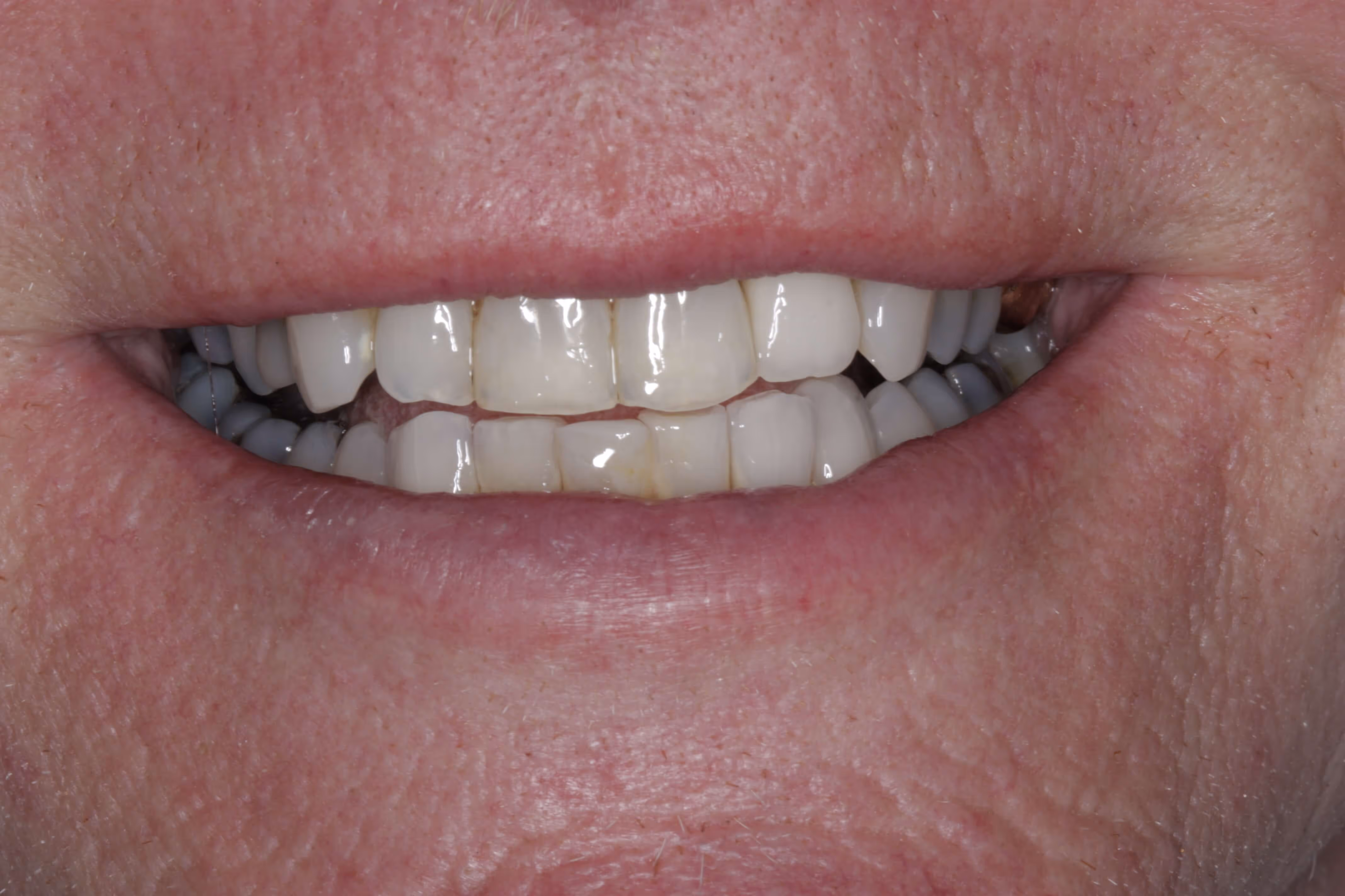 After dental implant treatment