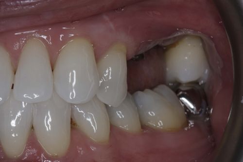 Before multiple dental implant treatment