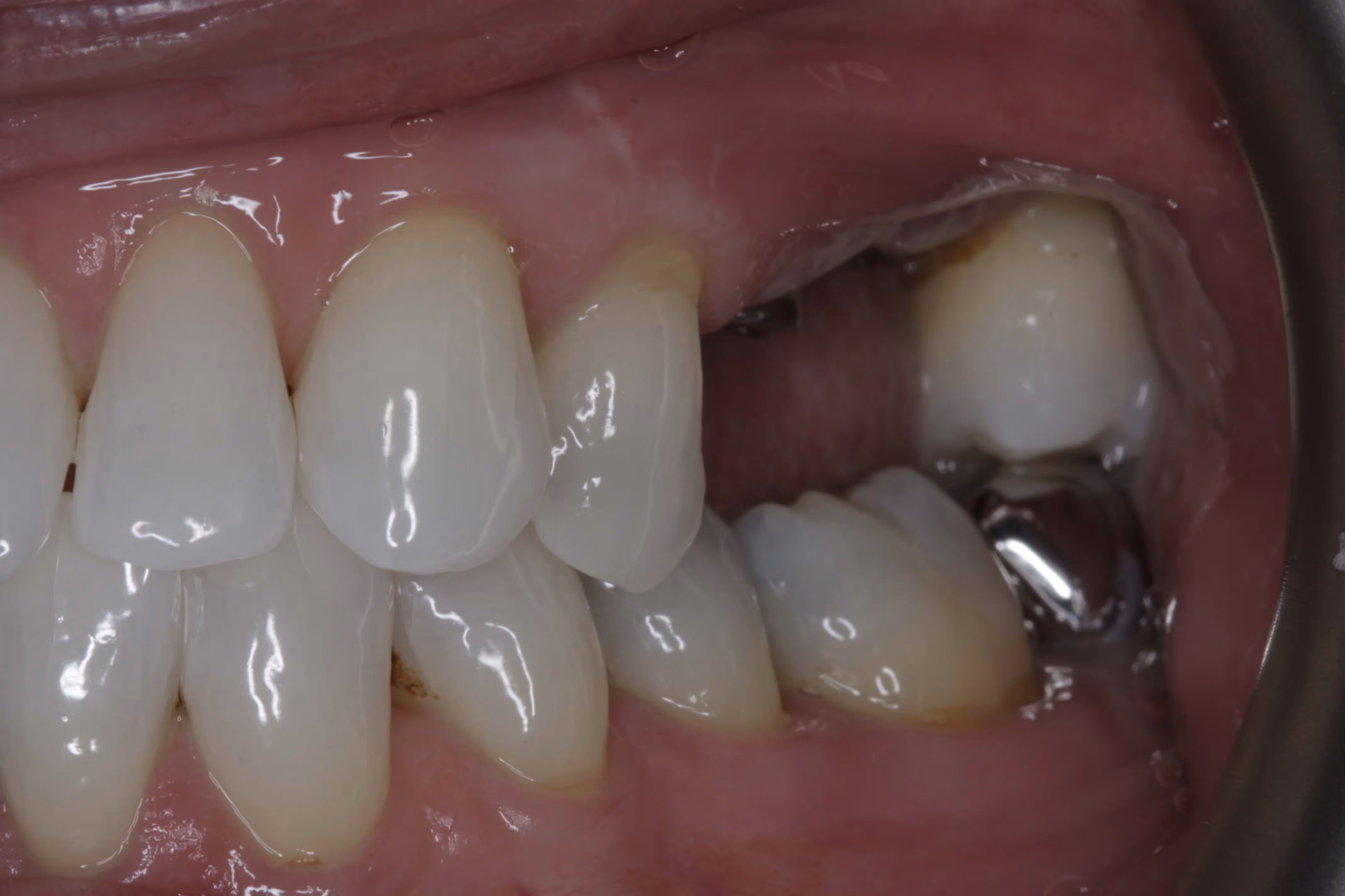 Before multiple dental implant treatment