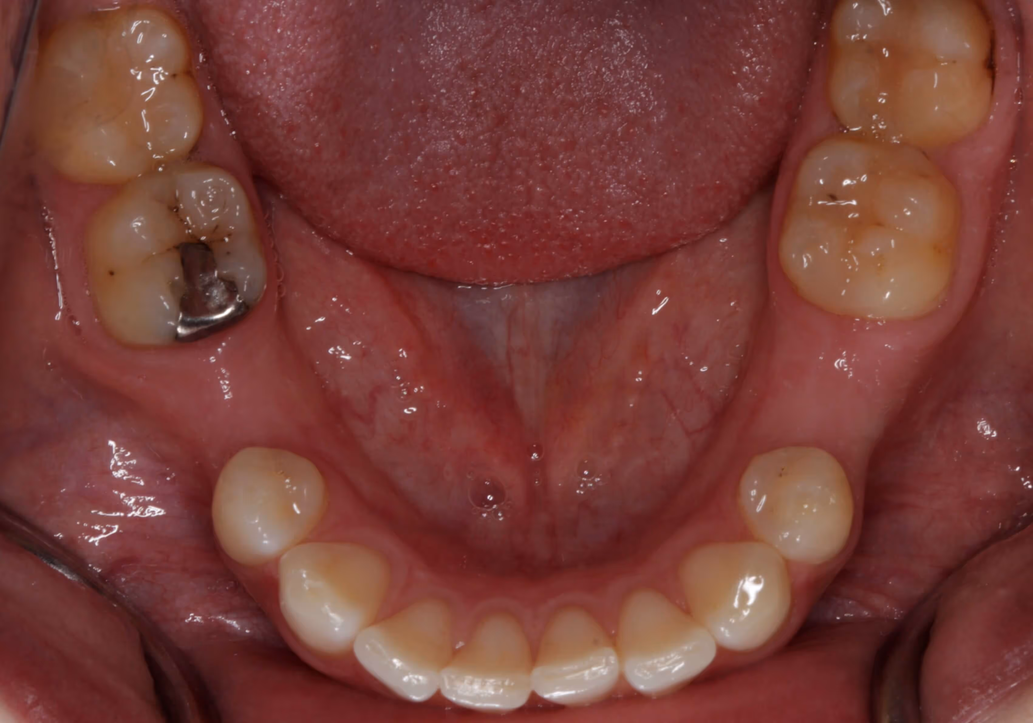 Before dental implant treatment