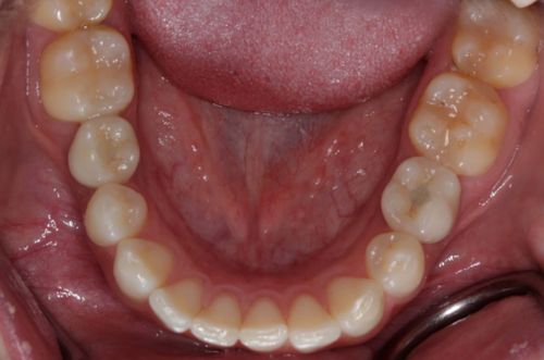 After dental implant treatment