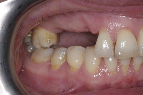 Before multiple dental implant treatment