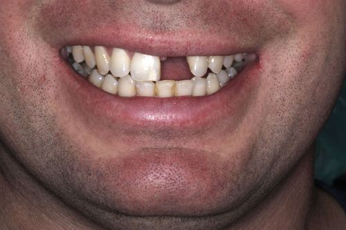 Before dental implant treatment