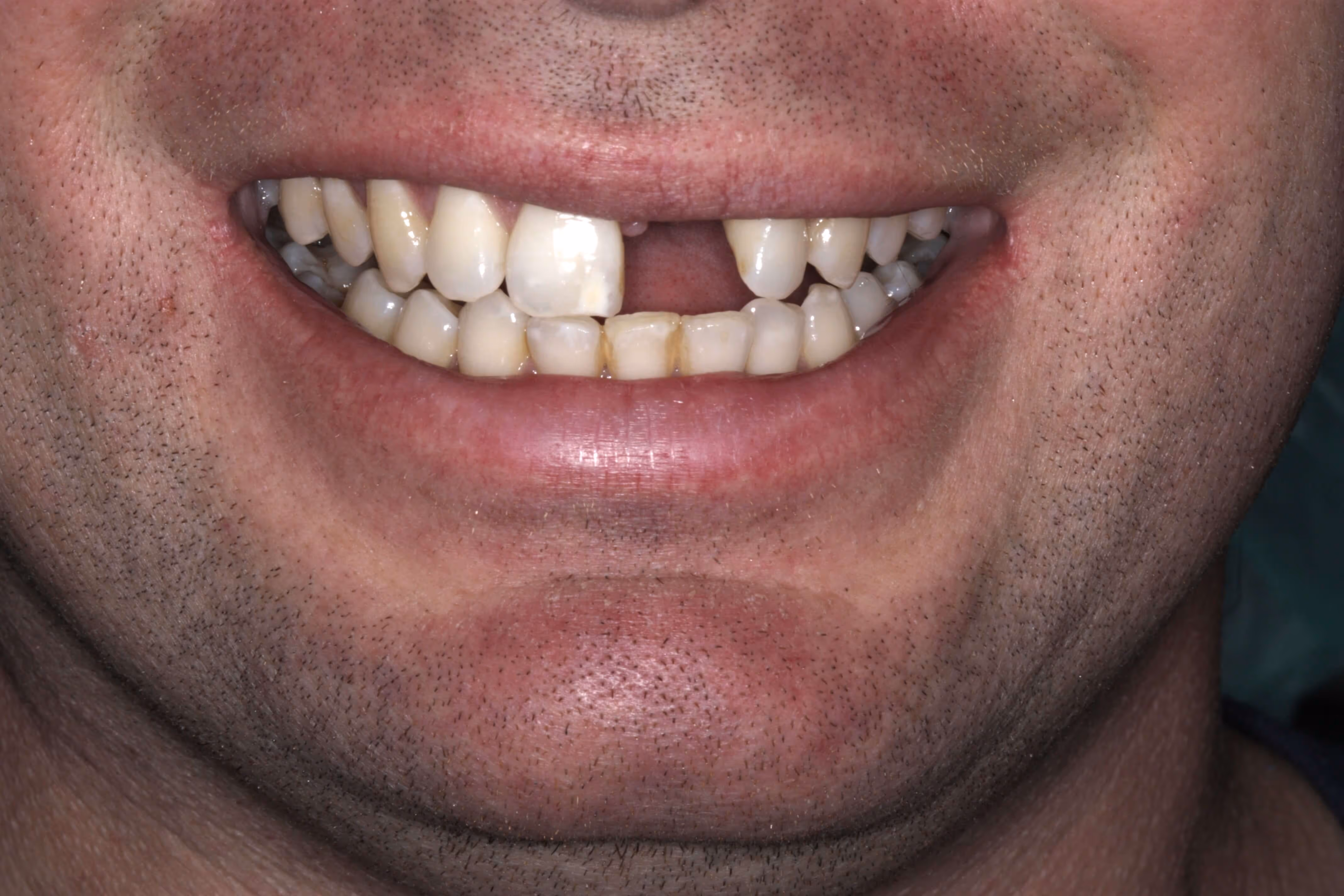 Before dental implant treatment