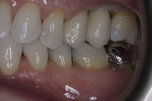After multiple dental implant treatment