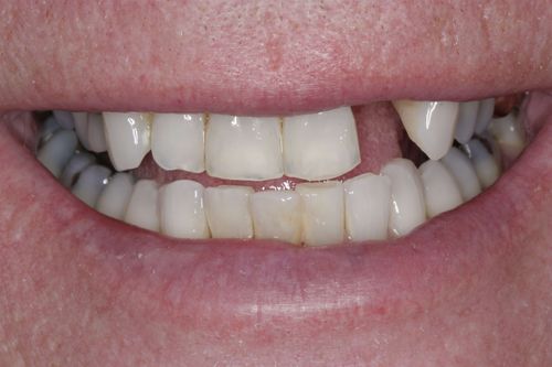 Before dental implant treatment